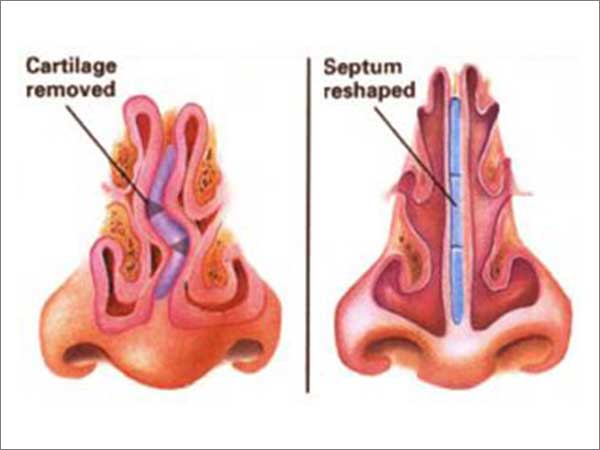 Turbinectomy & Septoplasty