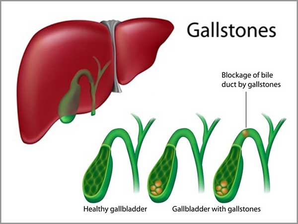 gallbladder disorders and gallstone pancreatitis