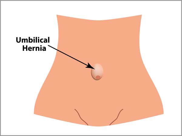 umbilical hernia repair